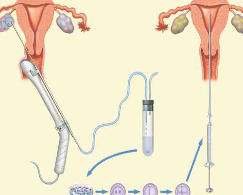 激素水平与多囊卵巢关系
